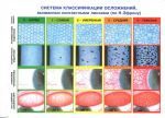 Система классификации осложнений вызванных контактными линзами (по Н. Эфрону) 
Производитель: 