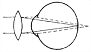 Схема коррекции дальнозоркости